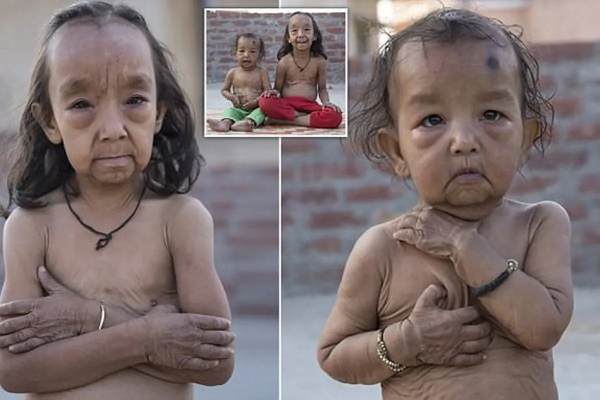 Dua Bocah Ini Alami Penuaan Dini, Titisan Benjamin Button?