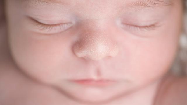 3 Jenis Ruam pada Bayi dan Cara Mengatasinya - Parenting ...