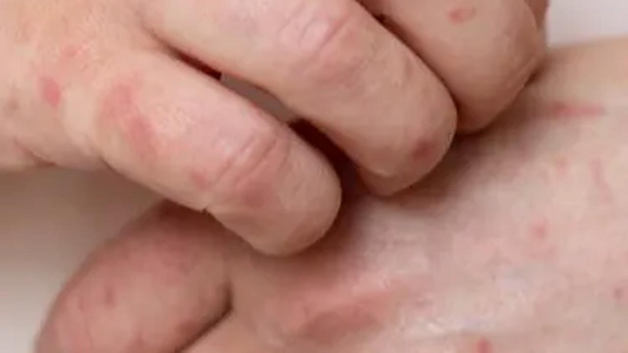 Jangan Seks Bebas, Ini Cara Jitu Cegah Terpapar Cacar Monyet