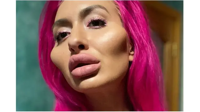 Lakukan Filler Pipi Sendiri, Wajah Wanita Ini Berubah Jadi Aneh