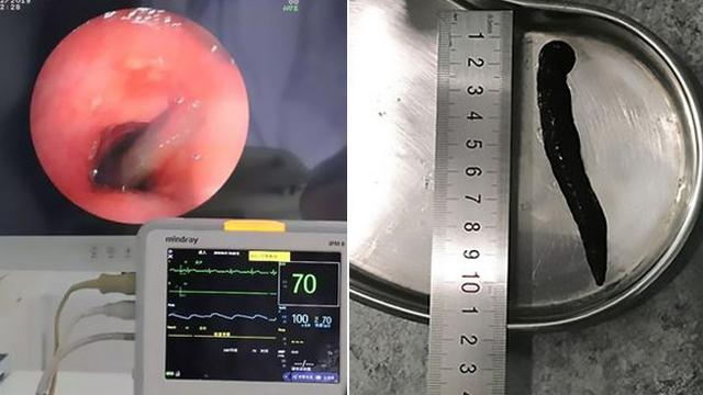 Batuk Darah Terus-Menerus, Ternyata Lintah Hidup di Tenggorokan Pria Ini