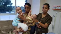 Kondisi Terkini Bayi Kembar Siam dari Sumatera Utara, Adam dan Malik (Foto: Reza Efendi/Liputan6.com)