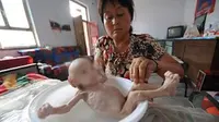 Balita Tak Punya Anus, Usia 3 Bulan Berat Badannya 2 Kg
