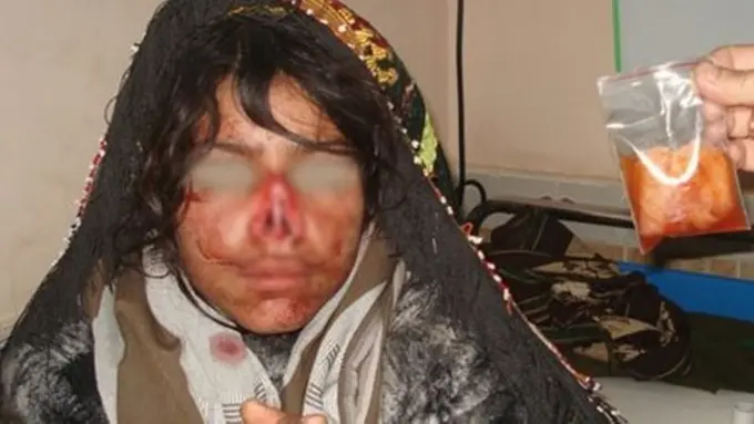 Sadis! Hidung Perempuan Ini Ditebas Habis oleh Suaminya