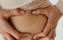 Stretch Mark pada Pria, Fakta, Penyebab dan Cara Pencegahannya