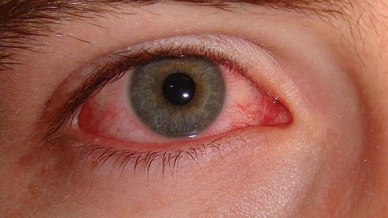 Tips Mencegah Tertular Sakit Mata