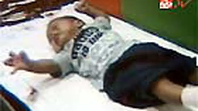 Epilepsi Tidak Menular dan Bisa Disembuhkan