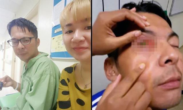 Mata Wei mengalami kebutaan akibat kebiasaan buruk gunakan kontak lensa saat tidur | Copyright by Viral4Real 