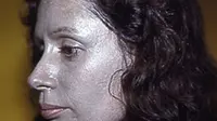 Argyria, Manusia dengan Kulit Biru Keabu-abuan