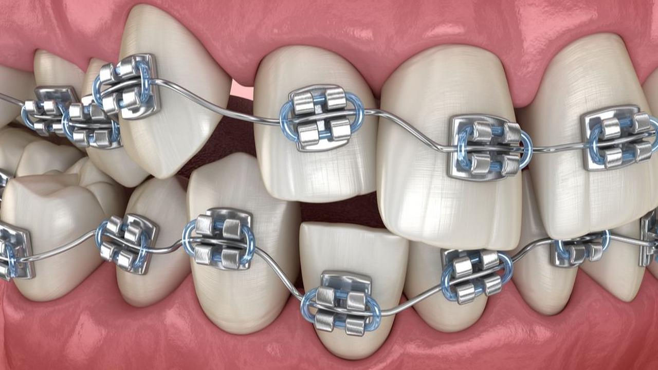 1. Behel Gigi Konvensional (Metal Braces)<br>