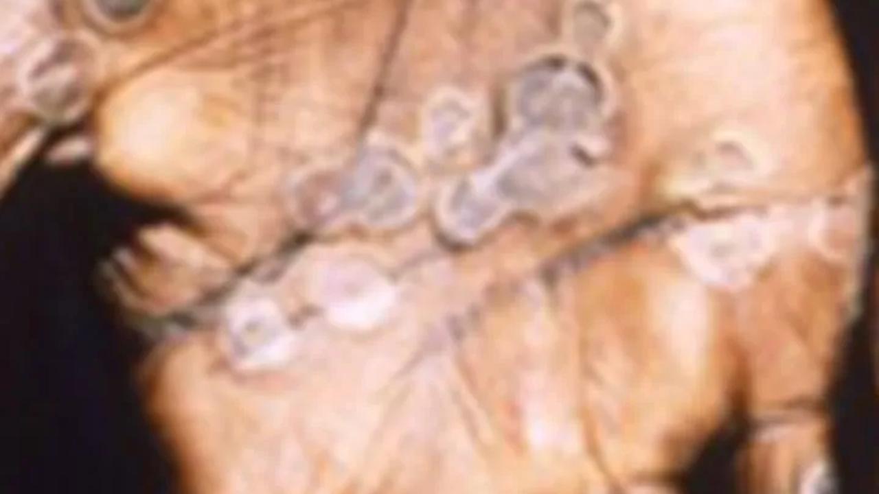 Dari hasil penelusuran diketahui enam pasien Monkeypox juga merupakan Orang Dengan HIV (ODHIV) dan memiliki orientasi Biseksual.<br>