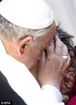 Penyakit ini tak menular. Paus Francis pernah mencium pernderita Neurofibromatosis. | Photo copyright Dailymail