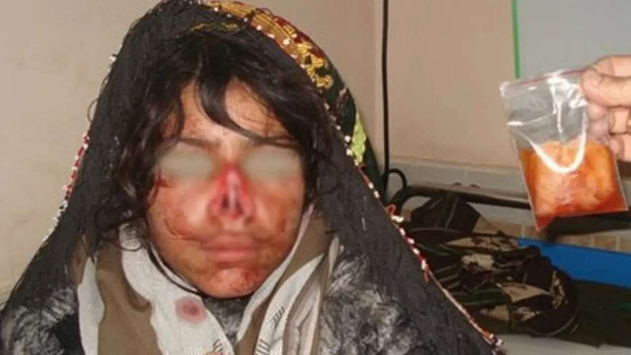 Sadis! Hidung Perempuan Ini Ditebas Habis oleh Suaminya