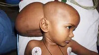 Seorang gadis kecil dengan kondisi tumor yang terus tumbuh dikepalanya kini dapat tersenyum kembali.