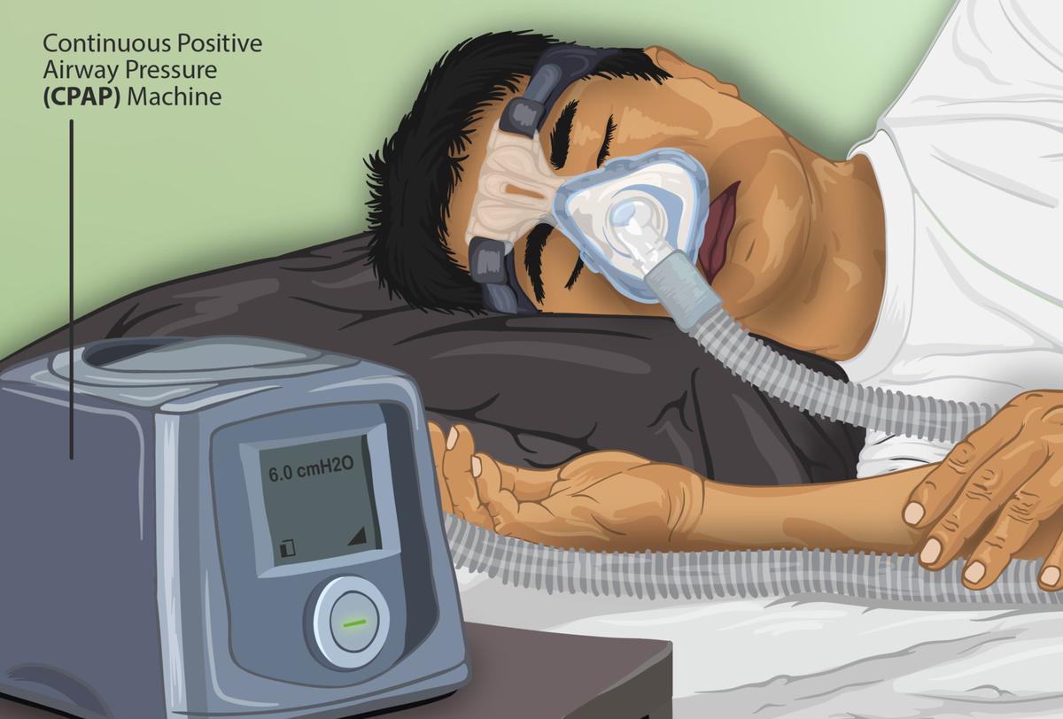 Pengobatan Sleep Apnea