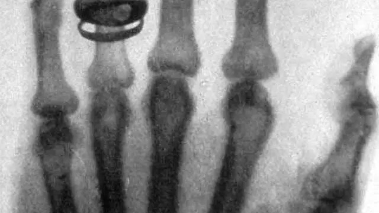 8 November 1895: Wilhelm Roentgen Menemukan X-Ray