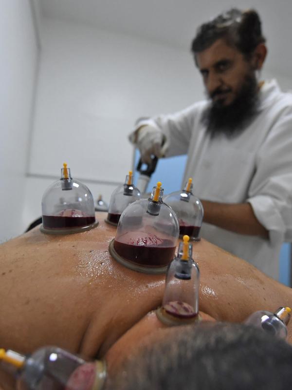 Spesialis melakukan pengobatan hijama atau terapi bekam basah kepada pasien di sebuah klinik di Ajman, Uni Emirat Arab, Kamis (15/8/2019). Terapi ini telah ditemukan dalam catatan kuno sejak 3500 tahun. (KARIM SAHIB/AFP)