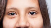 Fakta tentang Ptosis, Kondisi Medis yang Kerap Disebut sebagai ‘Mata Ngantuk’