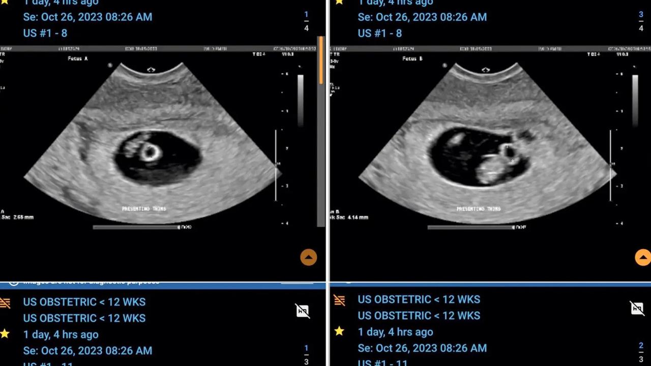 Hamil Dua Pasangan Kembar Identik, Wanita Ini Tuai Decak Kagum dari Tim Medis