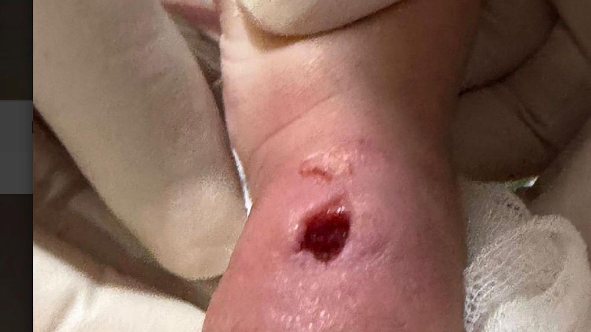 Viral Tangan Pasien Bayi Jadi Bengkak dan Berlubang Besar Usai Diinfus di RSIA Paramount