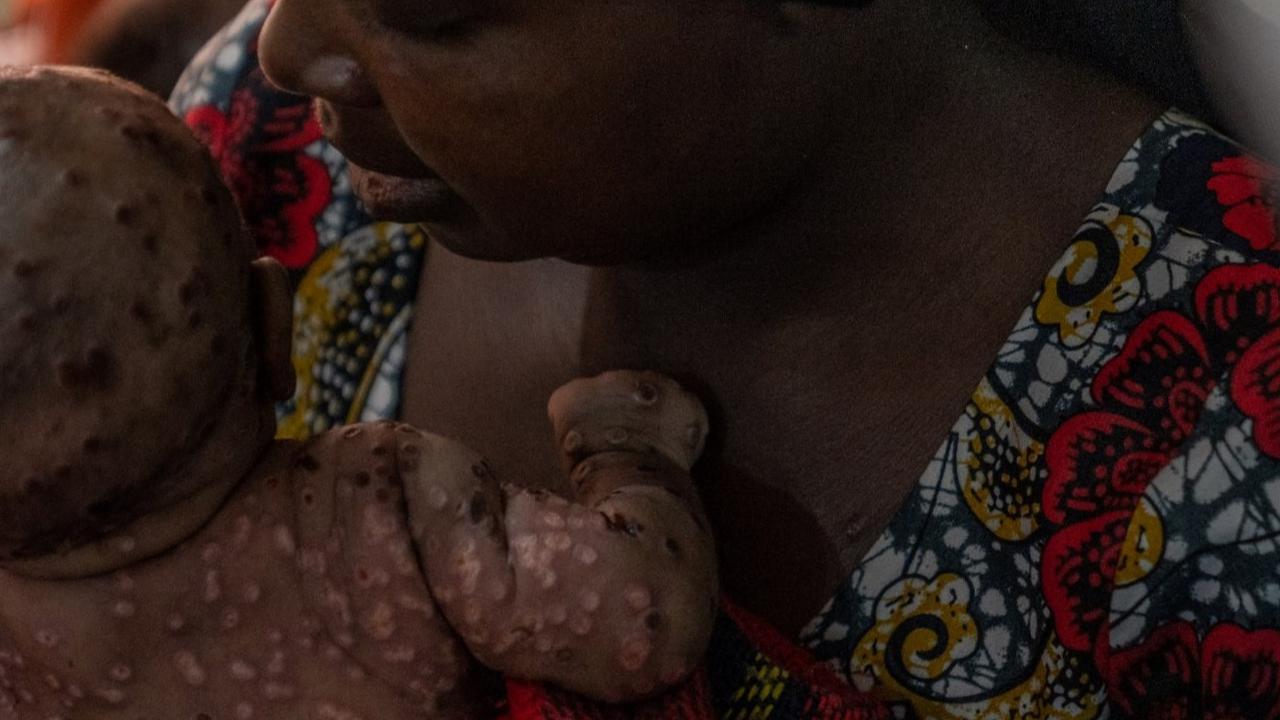 Wabah Mpox atau Cacar Monyet di Burundi