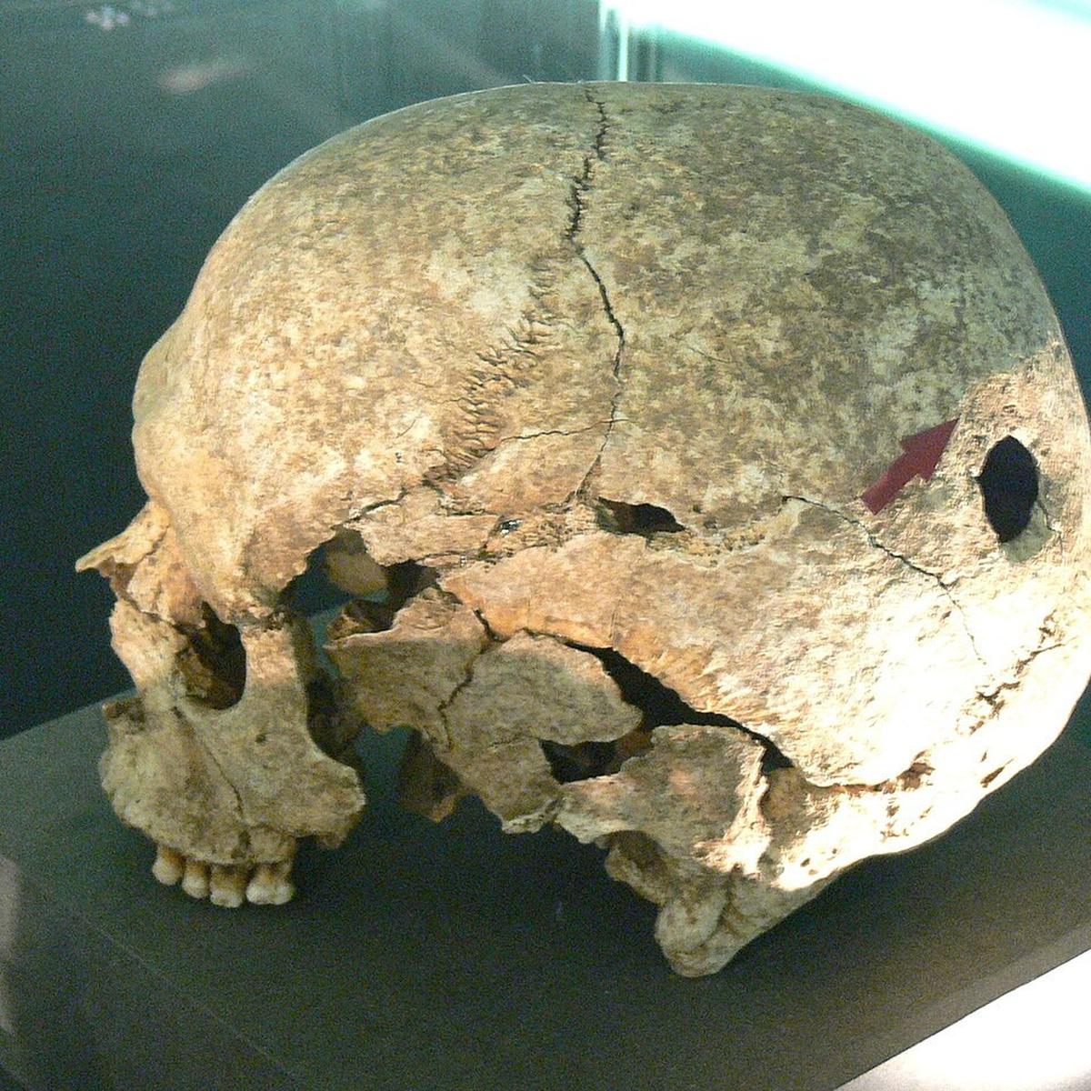 Trepanasi