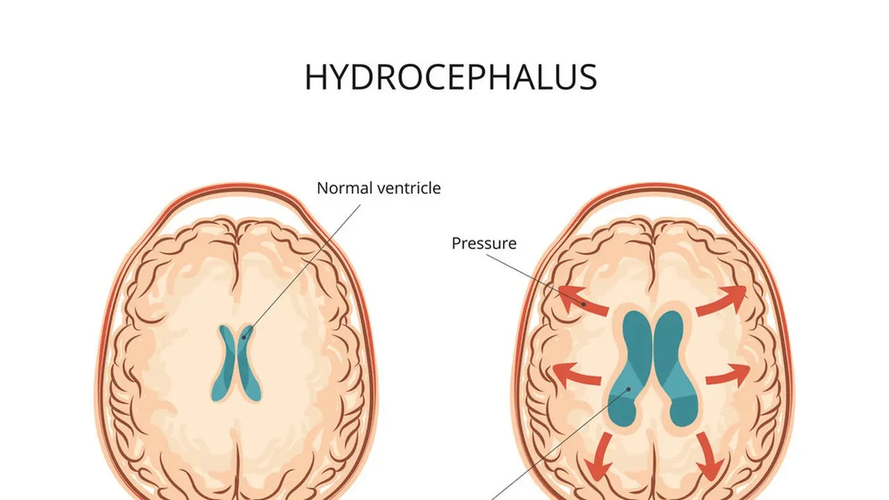 Hidrosefalus - KlikDokter.com (Logika600/Shutterstock)
