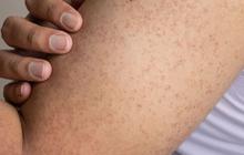 Keratosis Pilaris atau ‘Kulit Ayam’ Tak Lagi Menyebalkan, Panduan Lengkap Perawatan Kulit yang Tepat