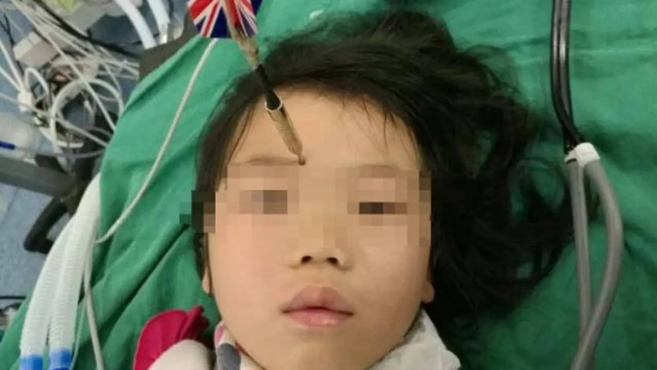 Asyik Bermain, Panah Tak Sengaja Tertancap di Dahi Bocah Ini
