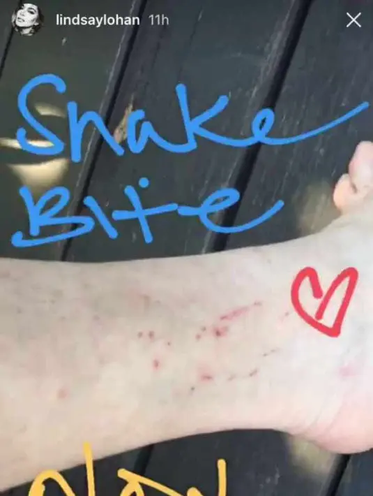 Aktris berusia 31 tahun tersebut mengunggah sebuah foto di Insta Storynya yang menunjukkan kaki yang habis digigit ular. (E! News)