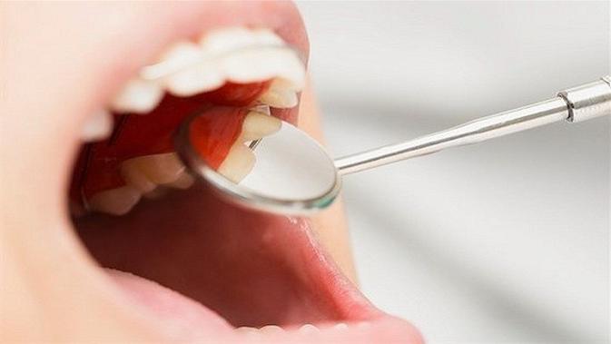 Infeksi gusi (periodontitis)