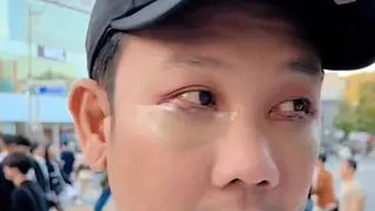 Dibujuk Istri, Denny Sumargo Jalani Prosedur Operasi Kantong Mata di Korea Selatan
