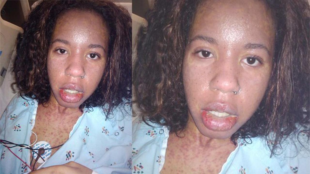 Idap Penyakit Langka, Tubuh Gadis Ini Melepuh hingga 80%