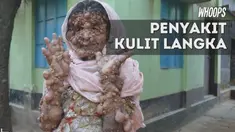 Seorang wanita dijuluki 'wanita kentang' karena menderita penyakit langka. Sekujur tubuhnya ditumbuhi tumor