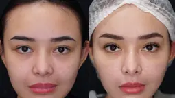 Inilah potret perbandingan sebelum dan sesudah Amanda Manopo tarik benang di wajahnya. Perubahan paras wanita keturunan Filipina, Spanyol, dan Minahasa ini sukses bikin pangling. (Liputan6.com/IG/@amandamanopo)