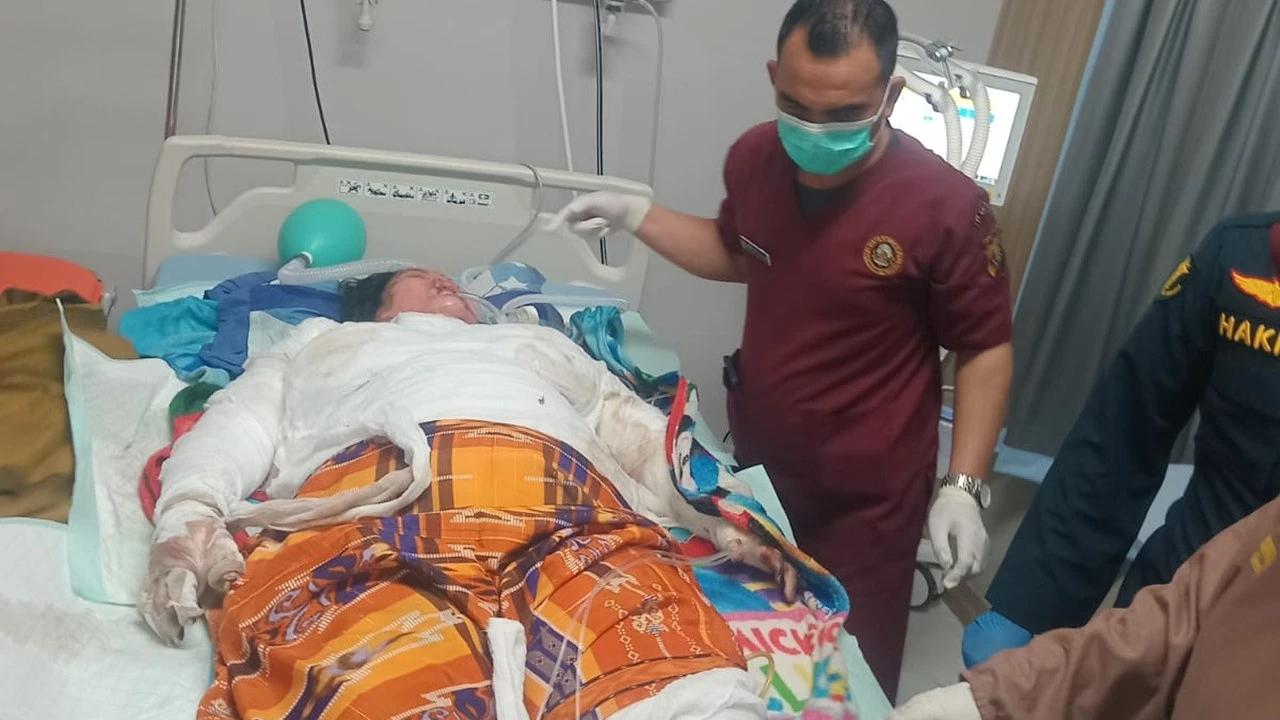 Luka Parah Akibat Terbakar, Jari Tangan Korban Selamat Kecelakaan Bus ALS-Truk Tangki Terancam Diamputasi