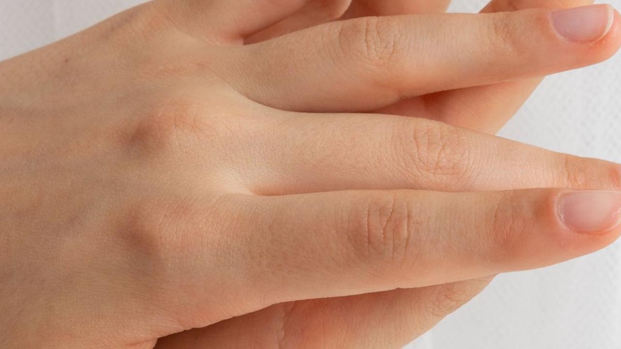 7 Tanda Seseorang Kurang Vitamin B12, Bisa Dilihat dari Telapak Tangan