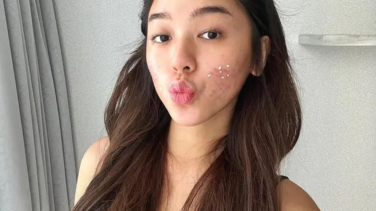 6 Potret Wajah Gabriella Ekaputri Berjerawat, Tetap Percaya Diri Tampil Natural
