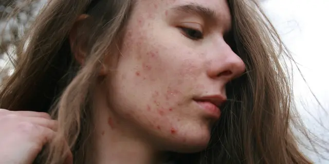 Panduan Tepat Memilih Acne Pad untuk Atasi Jerawat Sesuai Kebutuhan Spesifik