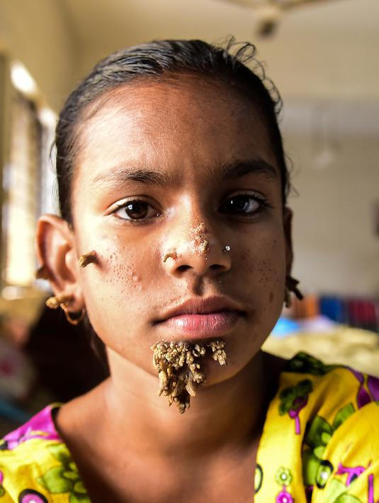 Sahana Khatun yang wajahnya ditumbuhi beberapa kutil menjalani perawatan di sebuah rumah sakit di Dhaka, Bangladesh, 30 Januari 2017. Gadis 10 tahun itu pun dianggap sebagai perempuan pertama di dunia yang memiliki kelainan "Tree Man Syndrome". (STR/AFP)
