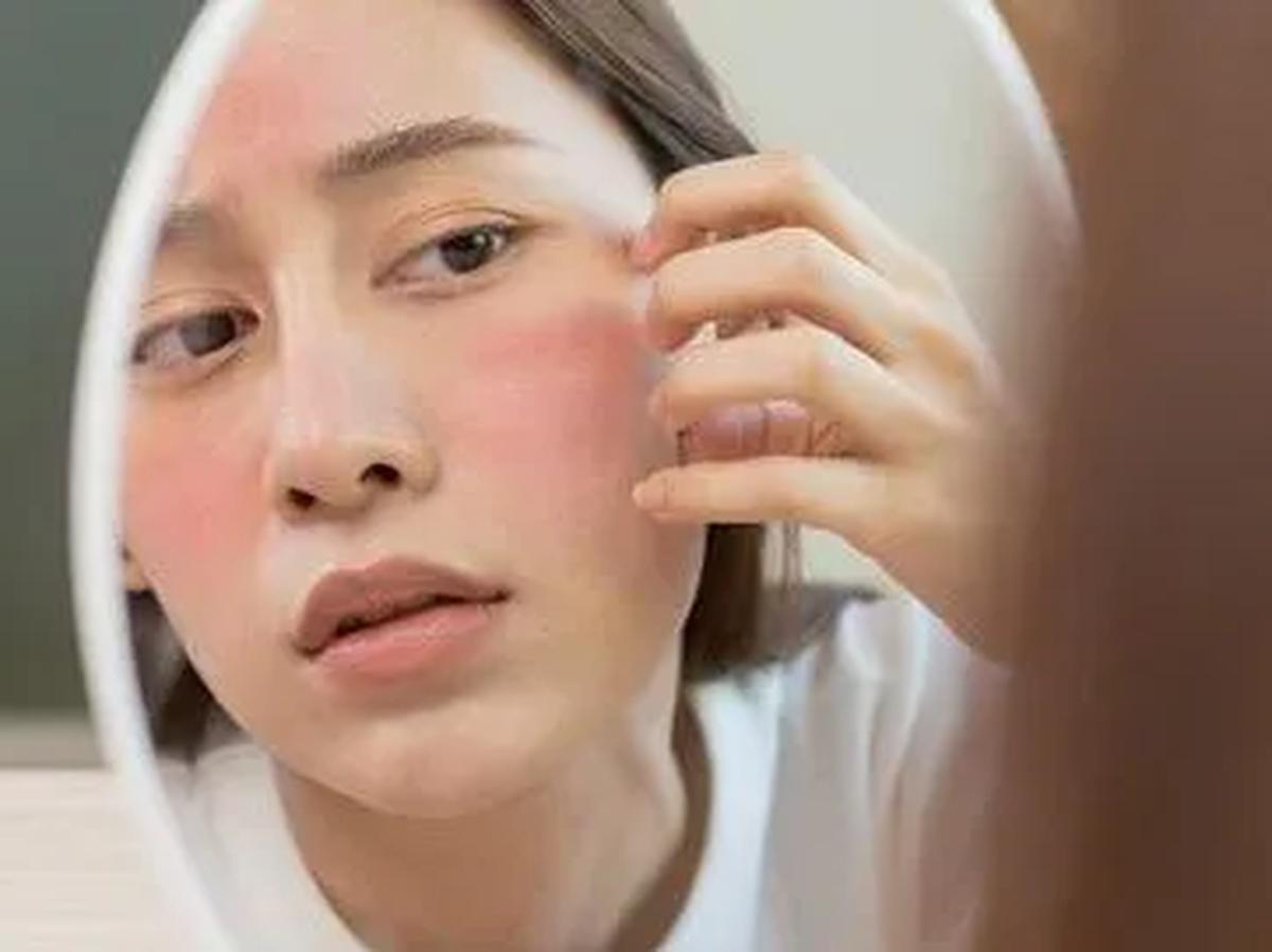 Cara Mengatasi Muka Gatal-Gatal