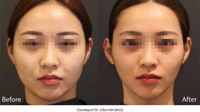 Kenalan dengan LINEAR Z yang Jadi The Next Level HIFU, Solusi Awet Muda Tanpa Operasi