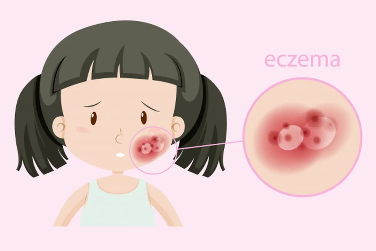 Gambar Ilustrasi Penderita Eksim