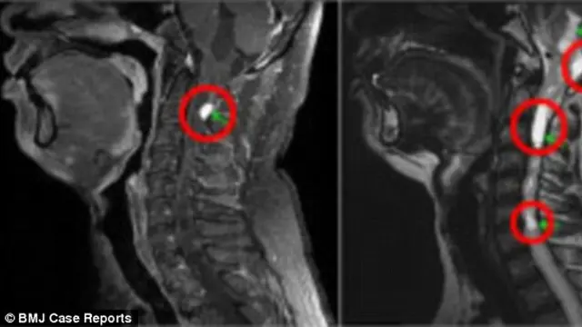 Lima Hari Cegukan, Pria Ini Memiliki Tumor di Lehernya