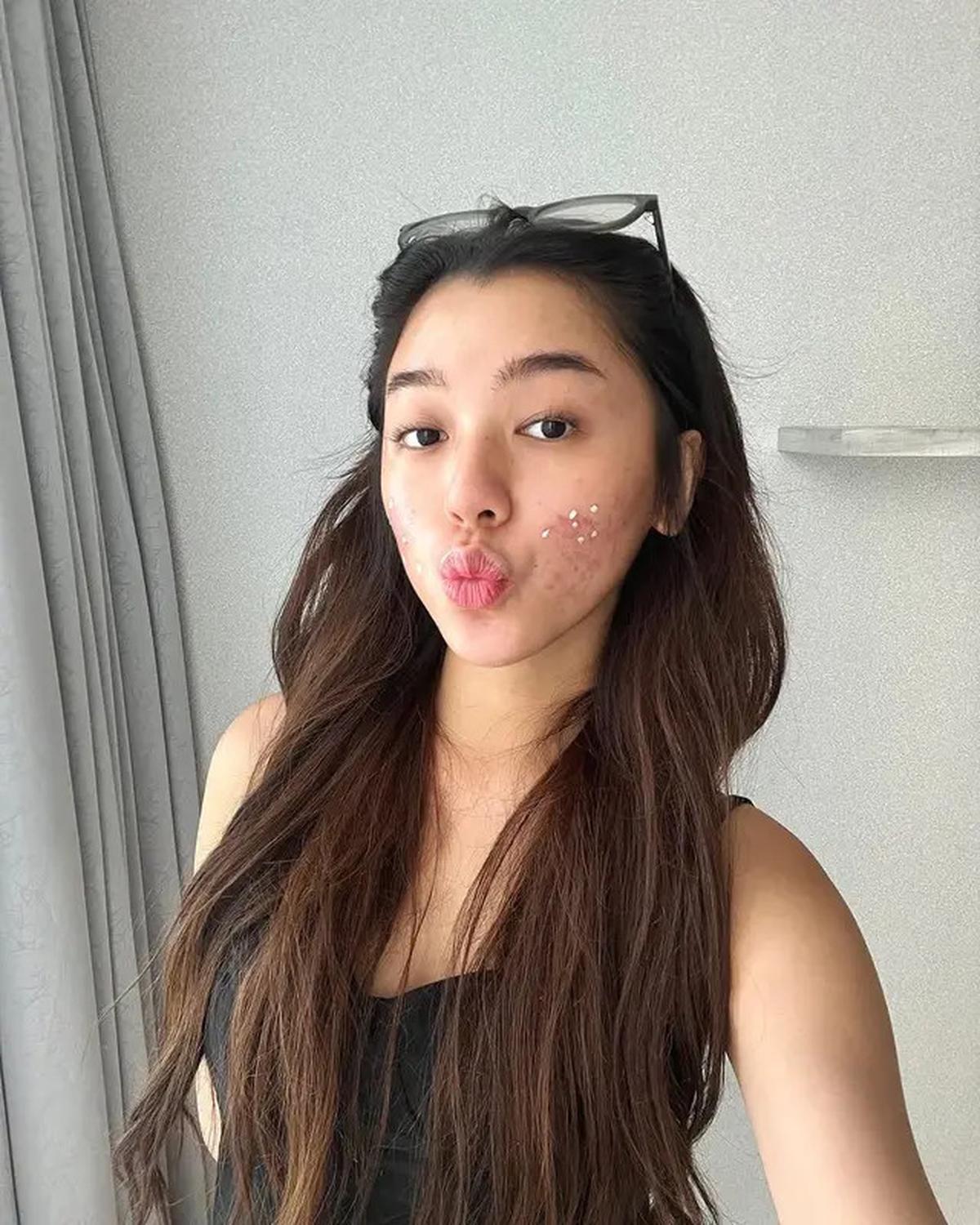 6 Potret Wajah Gabriella Ekaputri Berjerawat, Tetap Percaya Diri Tampil Natural
