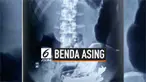 Dokter temukan 80 benda asing dari perut seorang pria India yang mengeluh sakit. Ketika dioperasi, ditemukan benda tak lazim dalam tubuh seperti gunting kuku hingga pipa rokok.