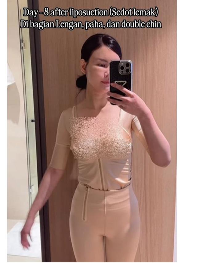 6 Potret Nita Gunawan Jalani Operasi Transfer Lemak ke Wajah Usai BB Turun 10 Kg