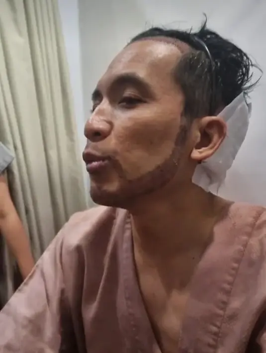 <p>Desta memberi testimoninya usai transplantasi rambut. Dia tidak merasa sakit karena dibius alias diberi anestesi. (Foto: Instagram/ dr_tompi)</p>