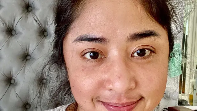 7 Potret Dewi Perssik saat Alami Gejala Corona Covid-19, Penuh Ruam Merah