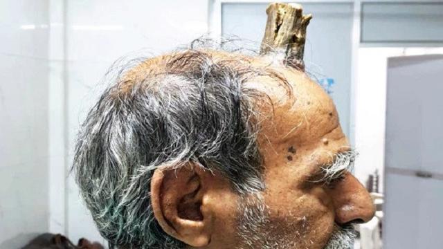 Ada tanduk tumbuh di kepala pria India ini
